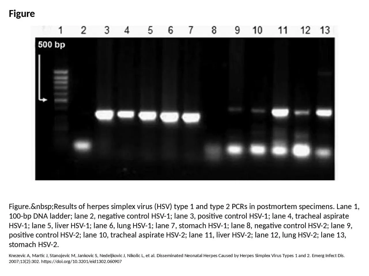 PPT-Figure Figure.&nbsp;Results of herpes simplex virus (HSV) type 1 and type 2 PCRs in