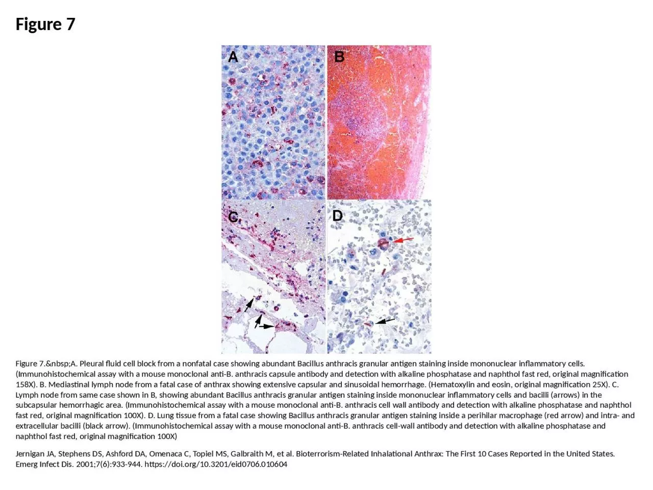 PPT-Figure 7 Figure 7.&nbsp;A. Pleural fluid cell block from a nonfatal case showing abundant