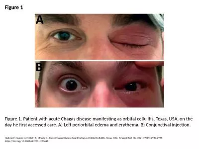 Figure 1 Figure 1. Patient with acute Chagas disease manifesting as orbital cellulitis, Texas, USA,