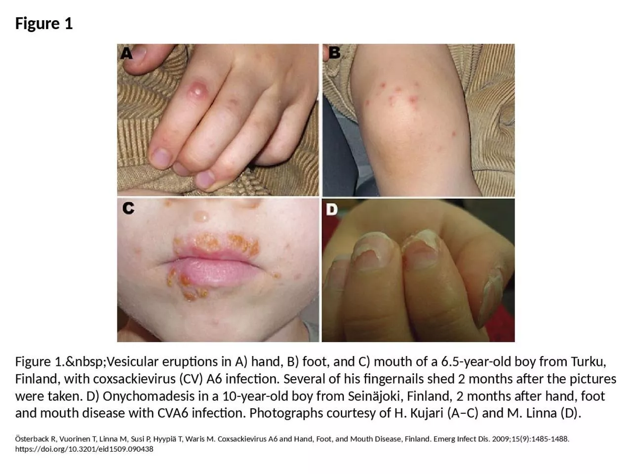 PPT-Figure 1 Figure 1.&nbsp;Vesicular eruptions in A) hand, B) foot, and C) mouth of a