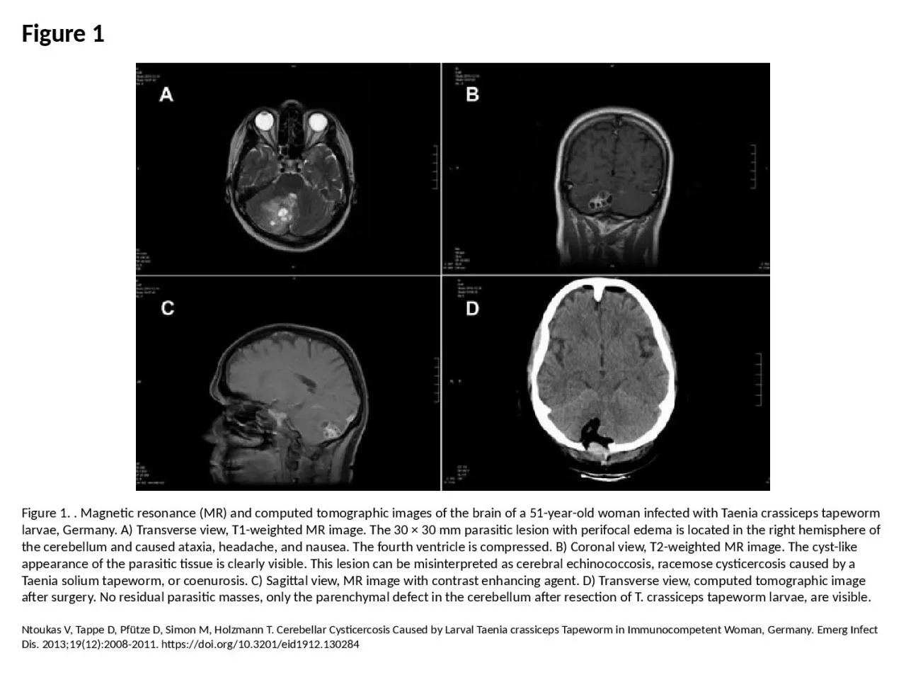 PPT-Figure 1 Figure 1. . Magnetic resonance (MR) and computed tomographic images of the brain