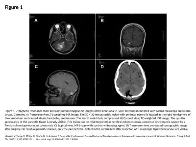 Figure 1 Figure 1. . Magnetic resonance (MR) and computed tomographic images of the brain of a 51-y