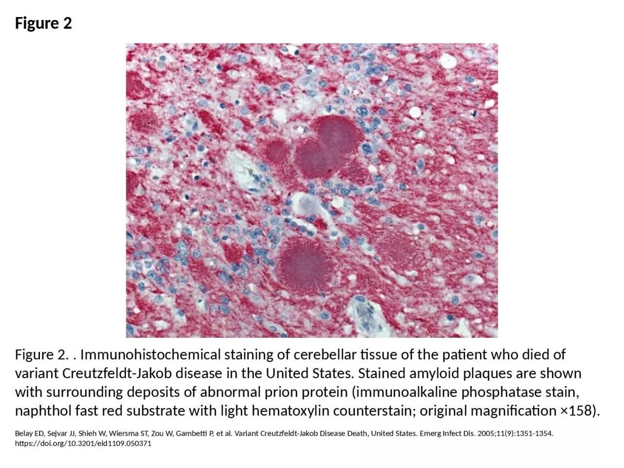 PPT-Figure 2 Figure 2. . Immunohistochemical staining of cerebellar tissue of the patient