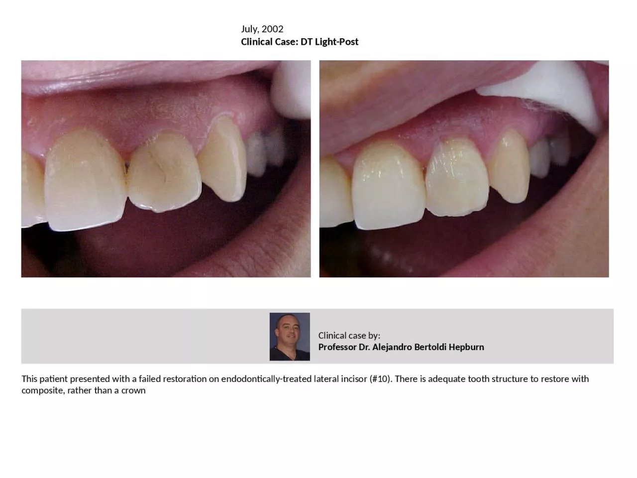 PPT-This patient presented with a failed restoration on endodontically-treated lateral incisor