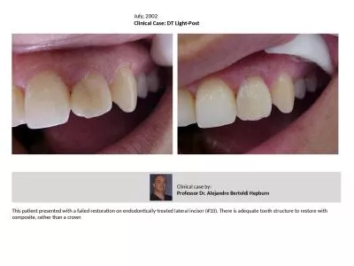 This patient presented with a failed restoration on endodontically-treated lateral incisor (#10). T