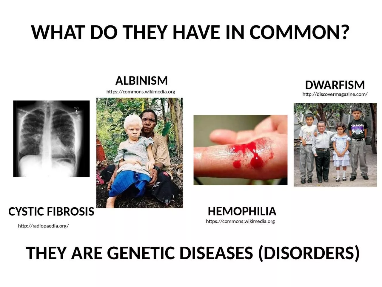 PPT-CYSTIC FIBROSIS ALBINISM