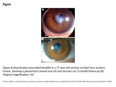 Figure Figure.&nbsp;Ameba-associated keratitis in a 17-year-old woman (contact lens